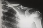 personal injury broken collar bone