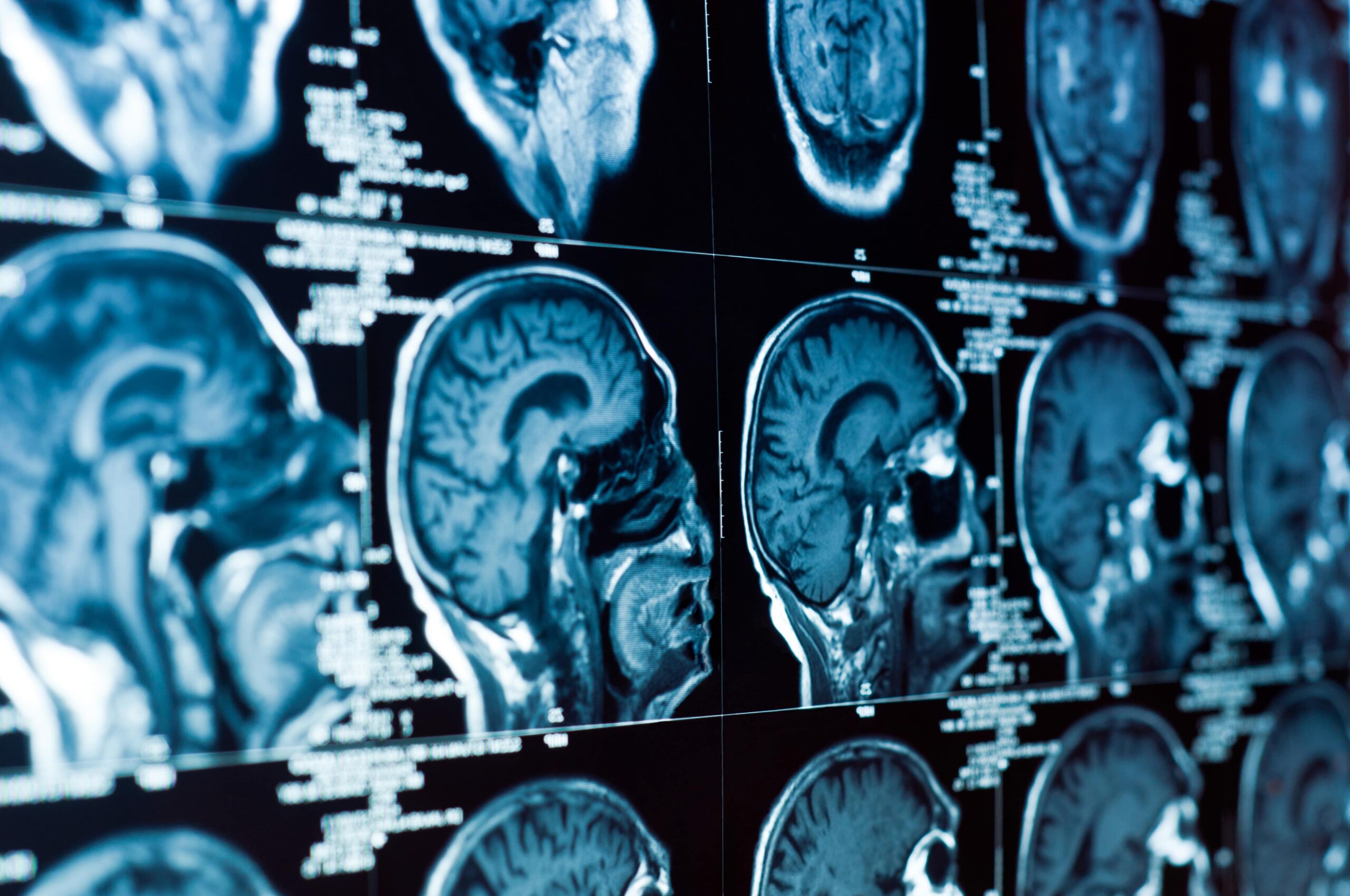 traumatic brain injury lawyer Milwaukee, WI